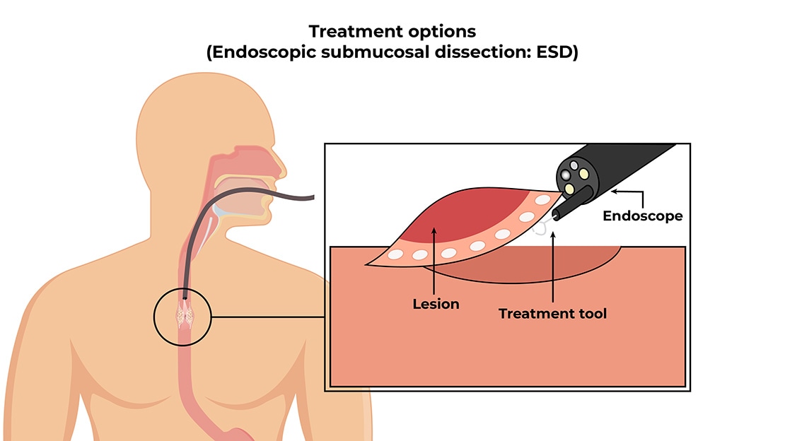 Treatment options(Endoscopic submucosal dissection:ESD)