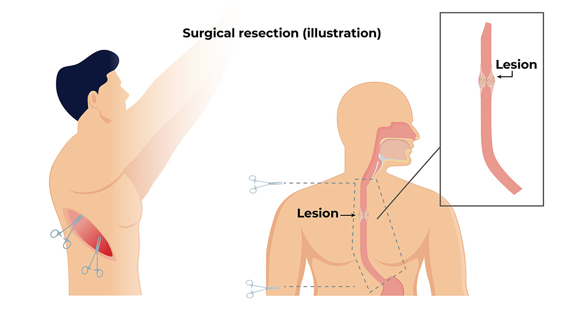 Surgical resection(illustration)